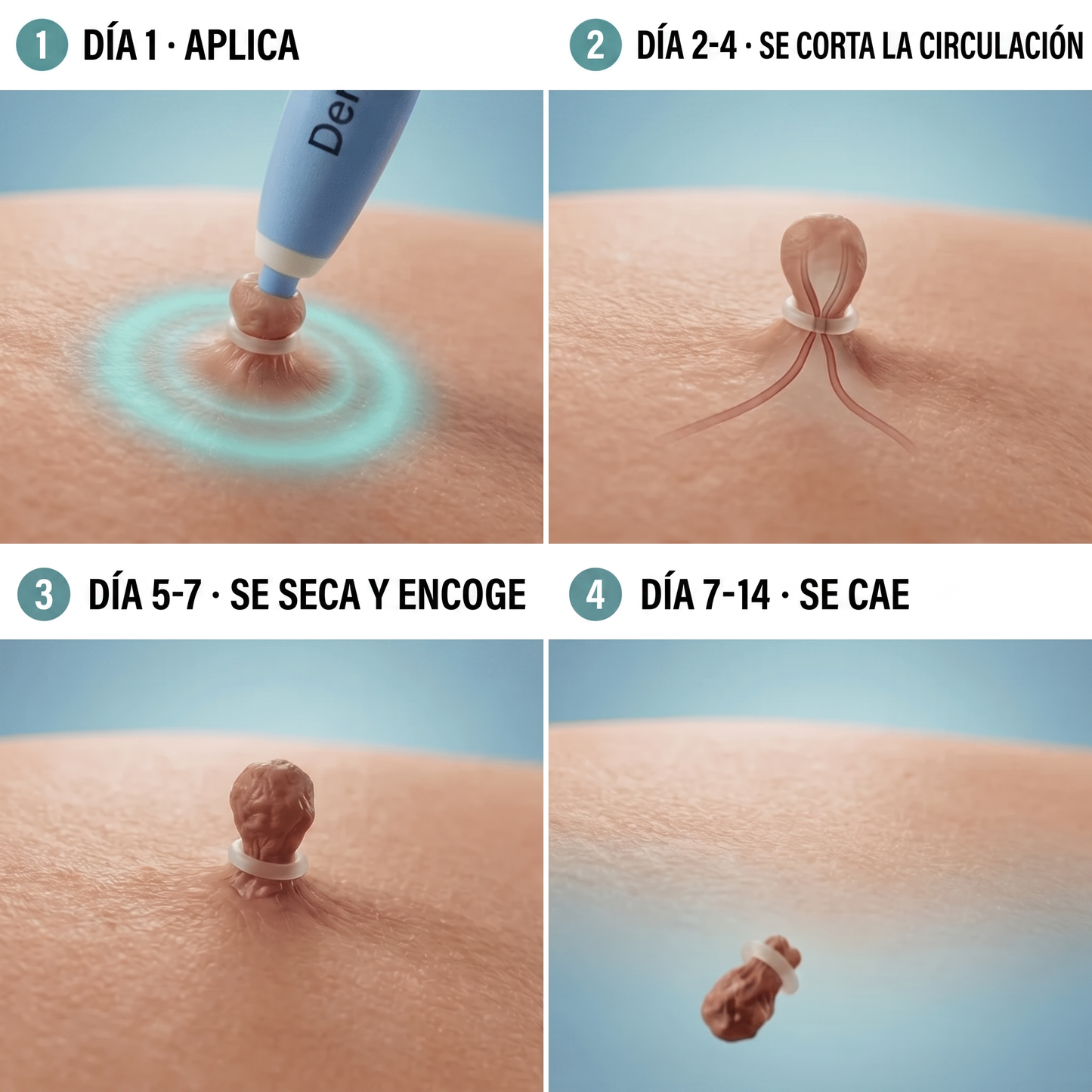 Kit Indoloro para Eliminar Verrugas